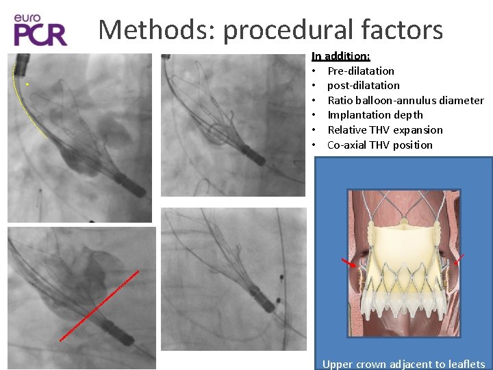 Methods: procedural factors * In addition: • Pre-dilatation • post-dilatation • Ratio balloon-annulus diameter