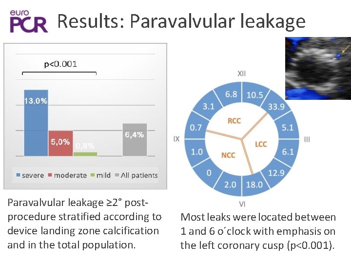 Results: Paravalvular leakage ≥ 2° postprocedure stratified according to device landing zone calcification and