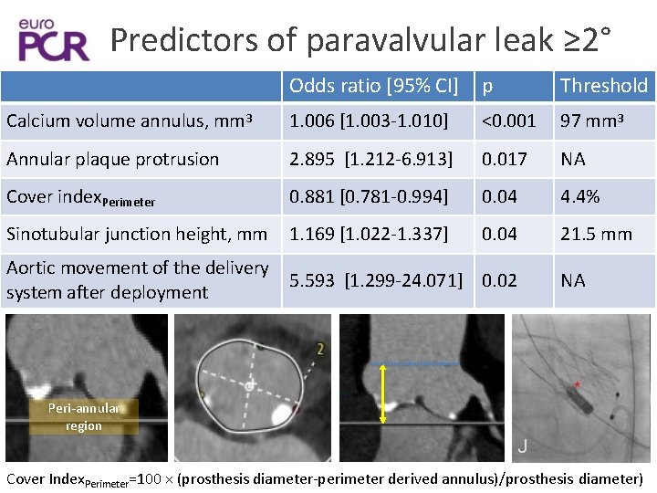 Predictors of paravalvular leak ≥ 2° Odds ratio [95% CI] p Threshold Calcium volume