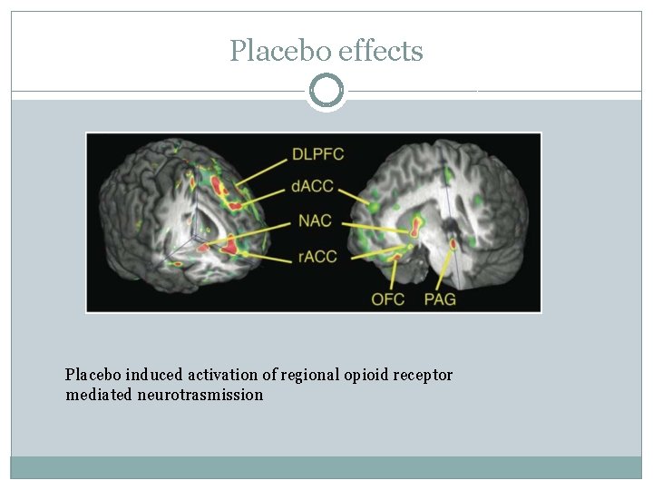 Placebo effects Placebo induced activation of regional opioid receptor mediated neurotrasmission 