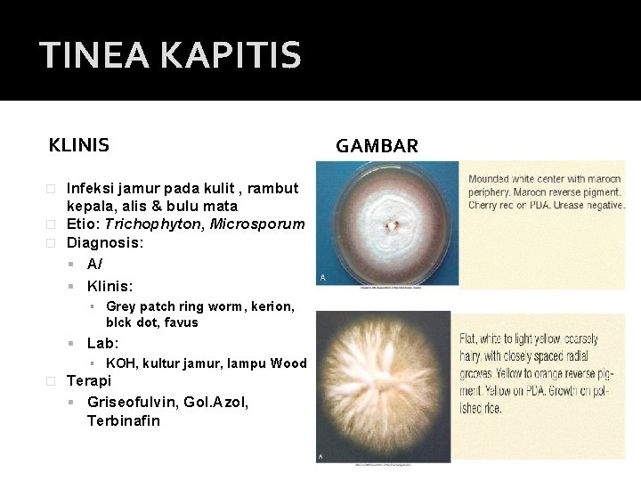 TINEA KAPITIS KLINIS Infeksi jamur pada kulit , rambut kepala, alis & bulu mata