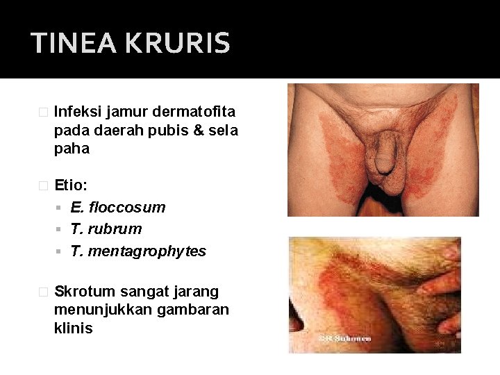 TINEA KRURIS � Infeksi jamur dermatofita pada daerah pubis & sela paha � Etio: