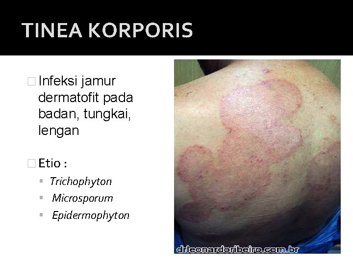 TINEA KORPORIS � Infeksi jamur dermatofit pada badan, tungkai, lengan � Etio : Trichophyton