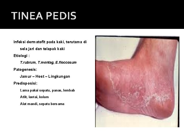 TINEA PEDIS Infeksi dermatofit pada kaki, terutama di sela jari dan telapak kaki Etiologi