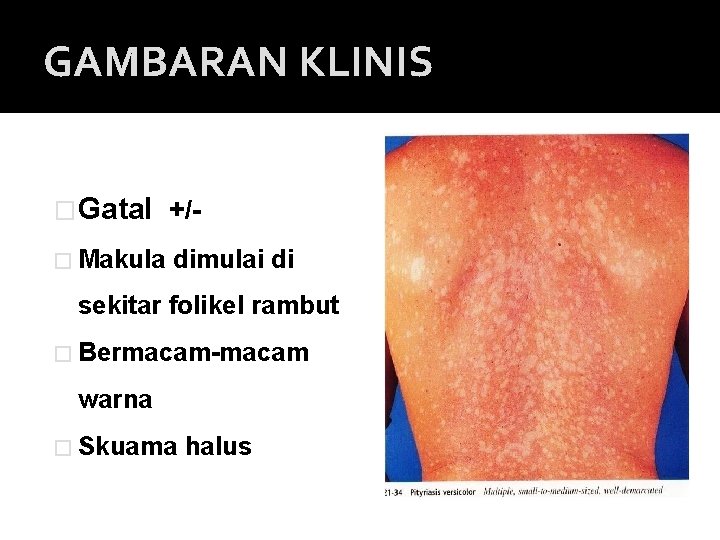 GAMBARAN KLINIS �Gatal +/� Makula dimulai di sekitar folikel rambut � Bermacam-macam warna �