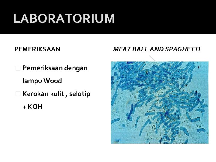 LABORATORIUM PEMERIKSAAN � Pemeriksaan dengan lampu Wood � Kerokan kulit , selotip + KOH