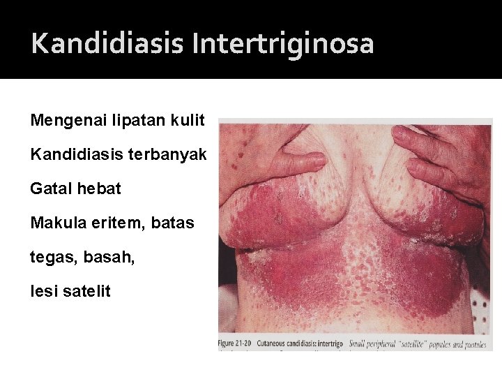 Kandidiasis Intertriginosa Mengenai lipatan kulit Kandidiasis terbanyak Gatal hebat Makula eritem, batas tegas, basah,