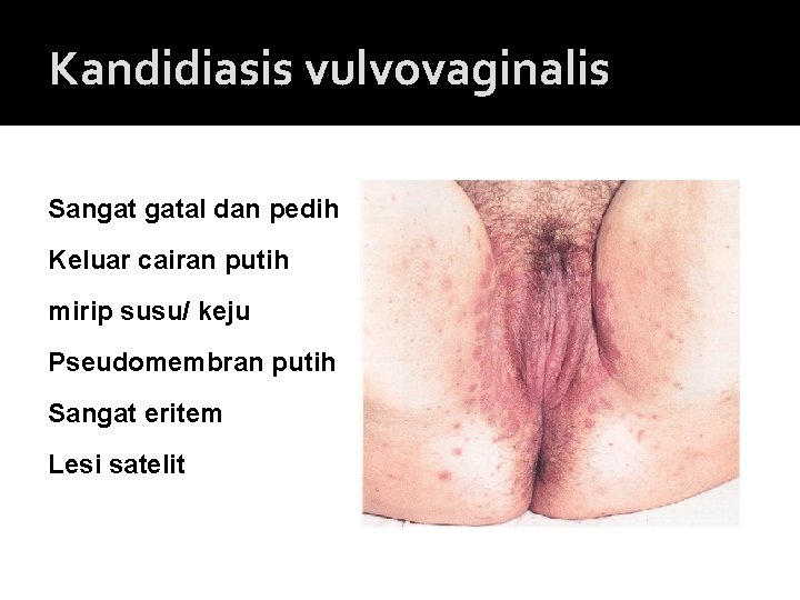 Kandidiasis vulvovaginalis Sangat gatal dan pedih Keluar cairan putih mirip susu/ keju Pseudomembran putih