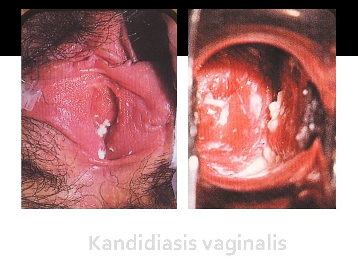 Kandidiasis vaginalis 