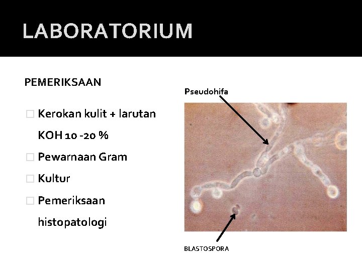 LABORATORIUM PEMERIKSAAN Pseudohifa � Kerokan kulit + larutan KOH 10 -20 % � Pewarnaan