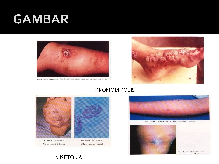 GAMBAR KROMOMIKOSIS MISETOMA 