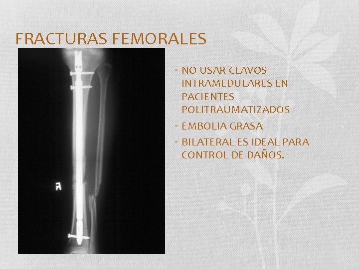 FRACTURAS FEMORALES • NO USAR CLAVOS INTRAMEDULARES EN PACIENTES POLITRAUMATIZADOS • EMBOLIA GRASA •