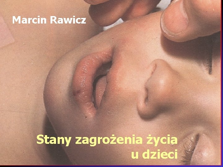Marcin Rawicz Stany zagrożenia życia u dzieci 