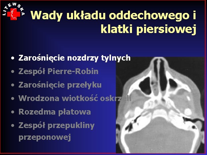 Wady układu oddechowego i klatki piersiowej • Zarośnięcie nozdrzy tylnych • Zespół Pierre-Robin •