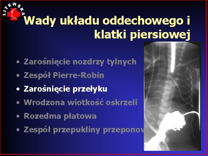 Wady układu oddechowego i klatki piersiowej • Zarośnięcie nozdrzy tylnych • Zespół Pierre-Robin •