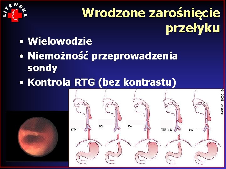 Wrodzone zarośnięcie przełyku • Wielowodzie • Niemożność przeprowadzenia sondy • Kontrola RTG (bez kontrastu)