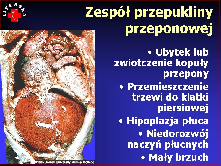 Zespół przepukliny przeponowej • Ubytek lub zwiotczenie kopuły przepony • Przemieszczenie trzewi do klatki