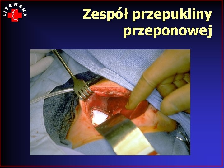 Zespół przepukliny przeponowej 