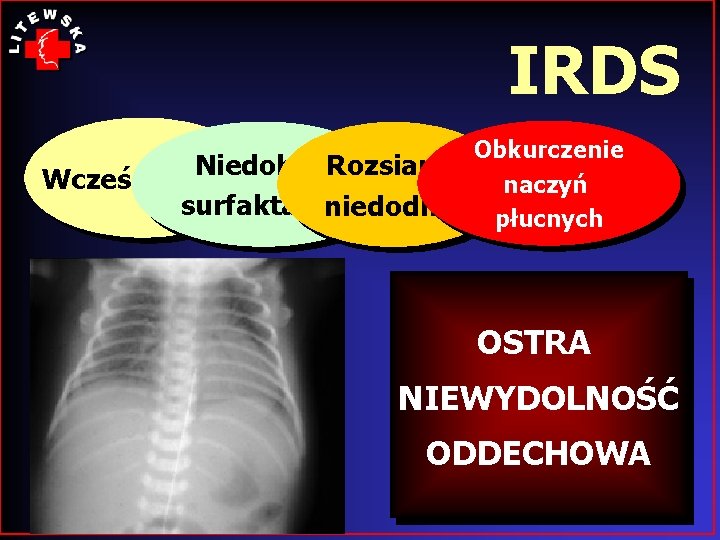 IRDS Obkurczenie Niedobór Rozsiana Wcześniactwo naczyń surfaktantu niedodma płucnych OSTRA NIEWYDOLNOŚĆ ODDECHOWA 