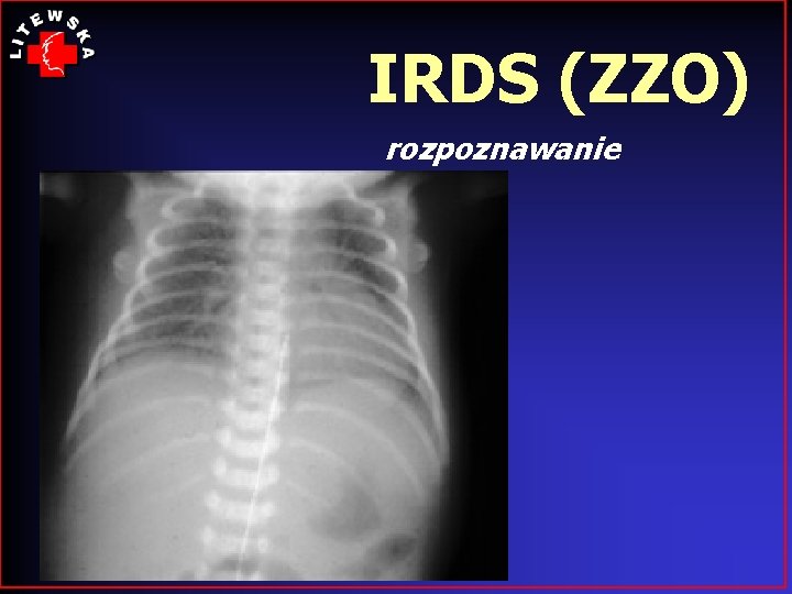 IRDS (ZZO) rozpoznawanie 