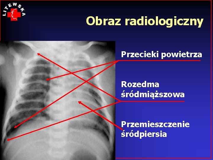 Obraz radiologiczny Przecieki powietrza Rozedma śródmiąższowa Przemieszczenie śródpiersia 