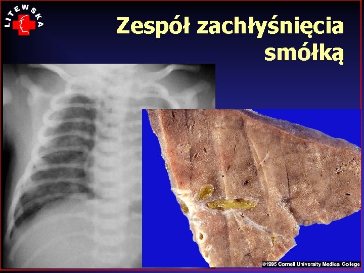 Zespół zachłyśnięcia smółką 