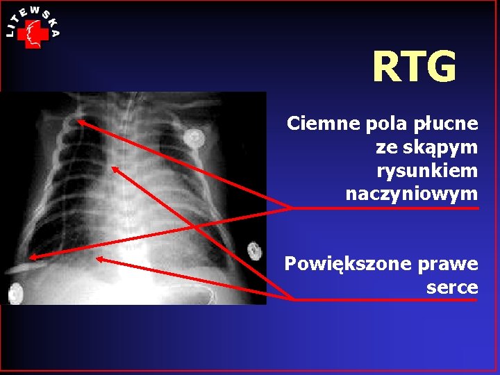 RTG Ciemne pola płucne ze skąpym rysunkiem naczyniowym Powiększone prawe serce 