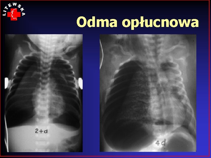 Odma opłucnowa 