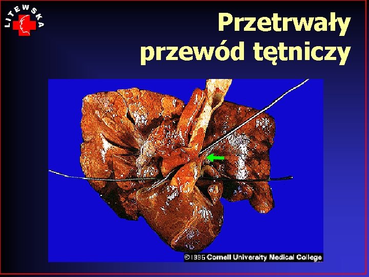 Przetrwały przewód tętniczy 