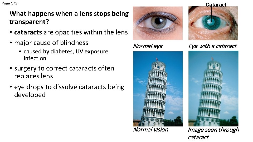 Page 579 Cataract What happens when a lens stops being transparent? • cataracts are