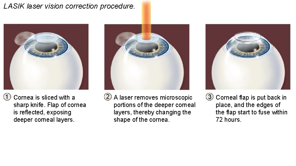 LASIK laser vision correction procedure. 1 Cornea is sliced with a sharp knife. Flap