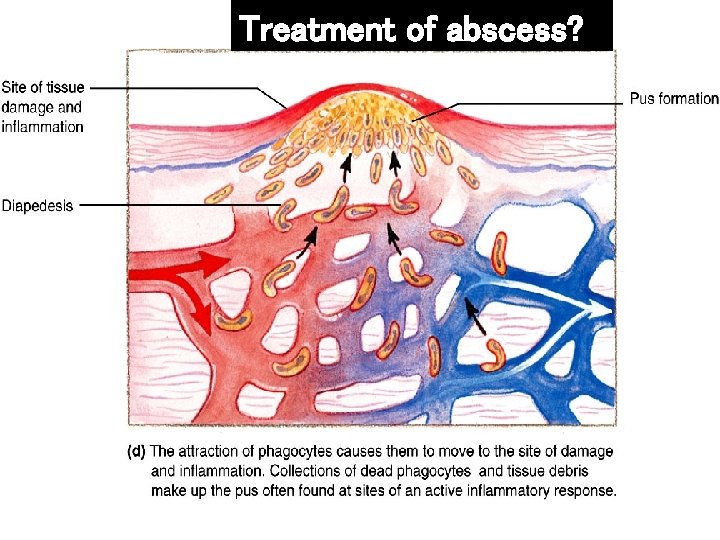 Treatment of abscess? 