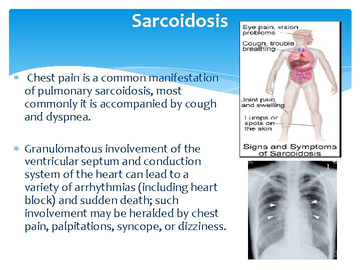 Sarcoidosis Chest pain is a common manifestation of pulmonary sarcoidosis, most commonly it is