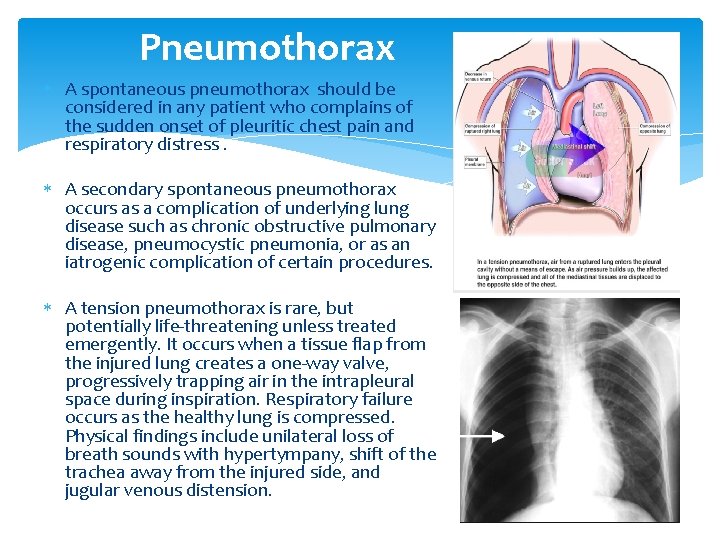 Pneumothorax A spontaneous pneumothorax should be considered in any patient who complains of the