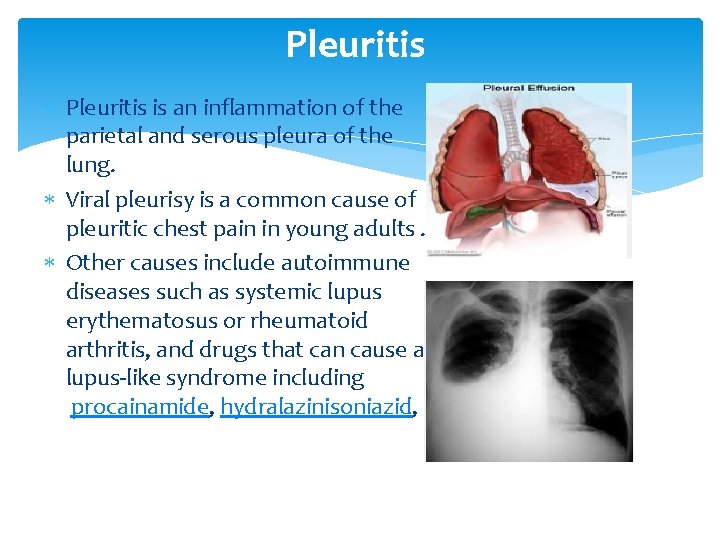 Pleuritis is an inflammation of the parietal and serous pleura of the lung. Viral