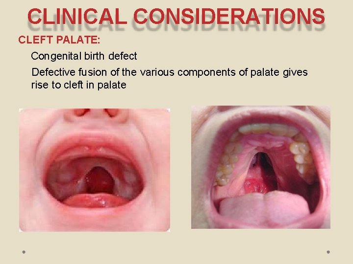 CLINICAL CONSIDERATIONS CLEFT PALATE: Congenital birth defect Defective fusion of the various components of