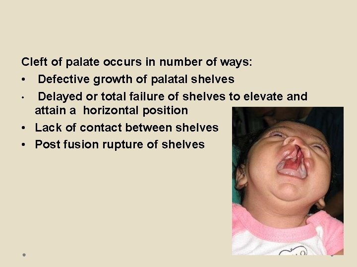 Cleft of palate occurs in number of ways: • Defective growth of palatal shelves