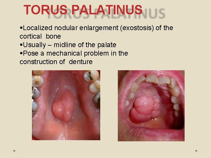 TORUS PALATINUS Localized nodular enlargement (exostosis) of the cortical bone Usually – midline of
