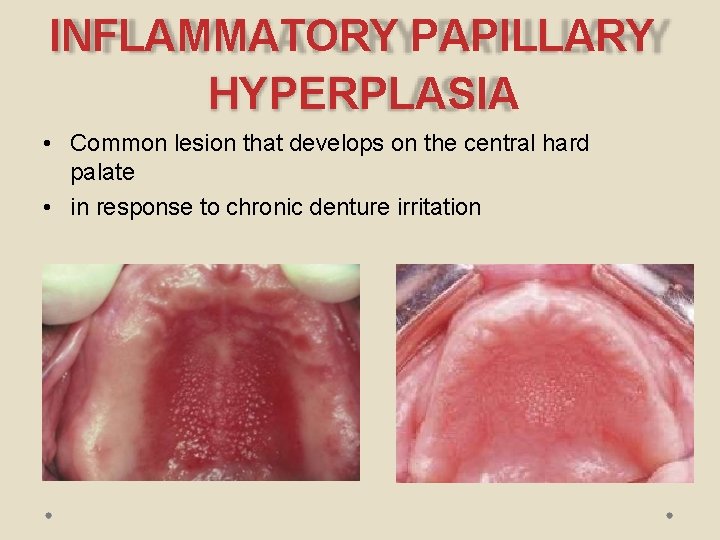 INFLAMMATORY PAPILLARY HYPERPLASIA • Common lesion that develops on the central hard palate •