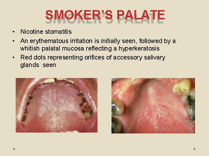 SMOKER’S PALATE • Nicotine stomatitis • An erythematous irritation is initially seen, followed by