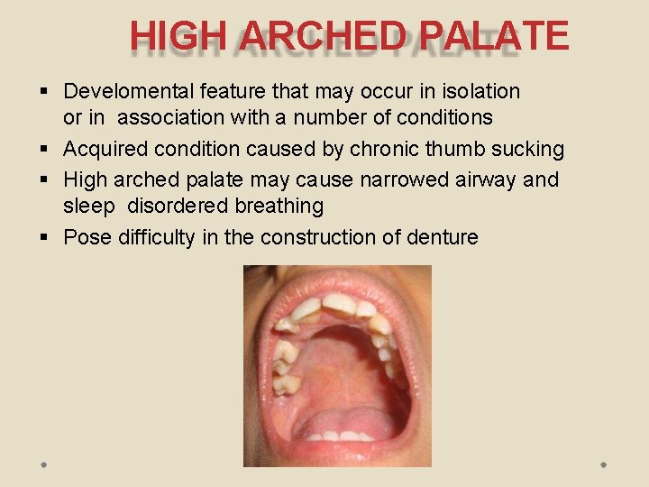 HIGH ARCHED PALATE Develomental feature that may occur in isolation or in association with