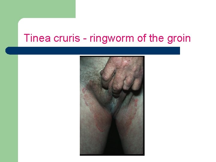 Tinea cruris - ringworm of the groin 
