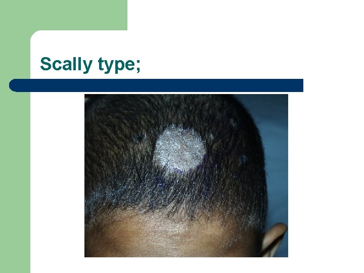Scally type; 