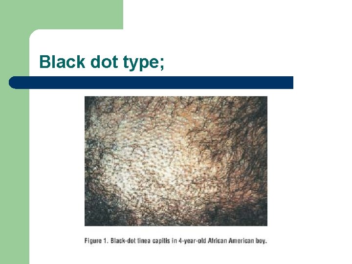 Black dot type; 