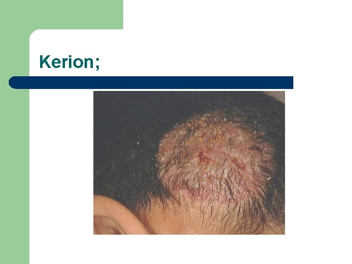 Kerion; 