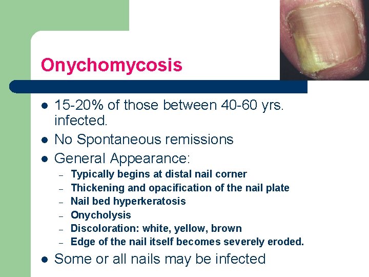 Onychomycosis l l l 15 -20% of those between 40 -60 yrs. infected. No
