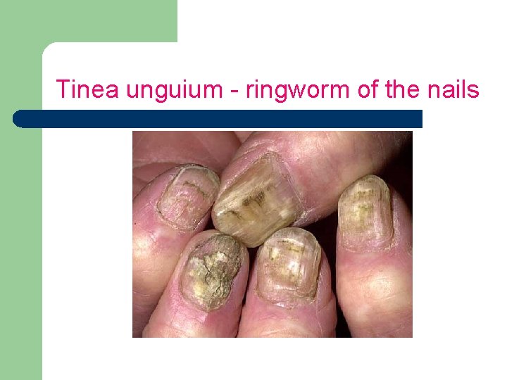 Tinea unguium - ringworm of the nails 