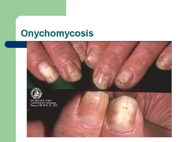 Onychomycosis 
