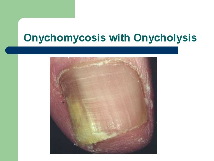 Onychomycosis with Onycholysis 