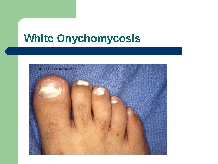 White Onychomycosis 